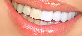 Teeth Whitening